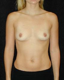 Breast Augmentation Before Photo by T.Y. Steven Ip, MD; Newport Beach, CA - Case 6911