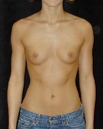 Breast Augmentation Before Photo by T.Y. Steven Ip, MD; Newport Beach, CA - Case 6914