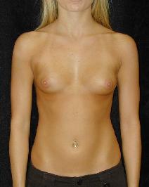Breast Augmentation Before Photo by T.Y. Steven Ip, MD; Newport Beach, CA - Case 6915