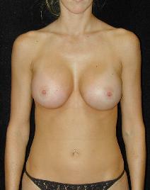 Breast Augmentation After Photo by T.Y. Steven Ip, MD; Newport Beach, CA - Case 6919