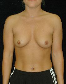 Breast Augmentation Before Photo by T.Y. Steven Ip, MD; Newport Beach, CA - Case 6920