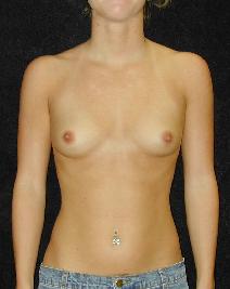 Breast Augmentation Before Photo by T.Y. Steven Ip, MD; Newport Beach, CA - Case 6921