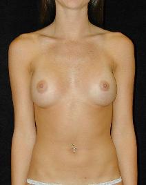 Breast Augmentation After Photo by T.Y. Steven Ip, MD; Newport Beach, CA - Case 6926