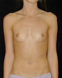 Breast Augmentation Before Photo by T.Y. Steven Ip, MD; Newport Beach, CA - Case 6926
