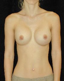 Breast Augmentation After Photo by T.Y. Steven Ip, MD; Newport Beach, CA - Case 6929