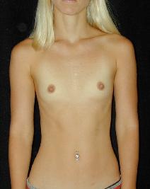 Breast Augmentation Before Photo by T.Y. Steven Ip, MD; Newport Beach, CA - Case 6929