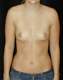 Breast Augmentation Before Photo by T.Y. Steven Ip, MD; Newport Beach, CA - Case 6931