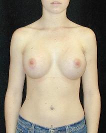 Breast Augmentation After Photo by T.Y. Steven Ip, MD; Newport Beach, CA - Case 6932