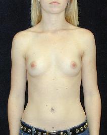 Breast Augmentation Before Photo by T.Y. Steven Ip, MD; Newport Beach, CA - Case 6932