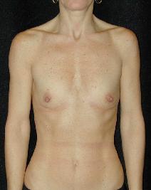 Breast Augmentation Before Photo by T.Y. Steven Ip, MD; Newport Beach, CA - Case 6933