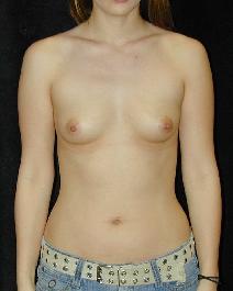 Breast Augmentation Before Photo by T.Y. Steven Ip, MD; Newport Beach, CA - Case 6935