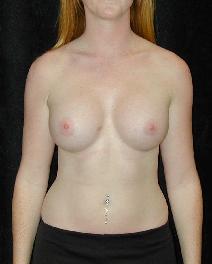 Breast Augmentation After Photo by T.Y. Steven Ip, MD; Newport Beach, CA - Case 6938