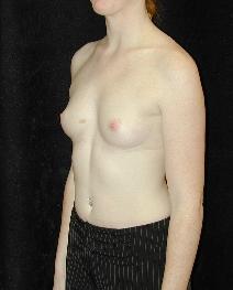 Breast Augmentation Before Photo by T.Y. Steven Ip, MD; Newport Beach, CA - Case 6938