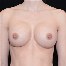 Breast Augmentation After Photo by Judith Gurley, M.D., F.A.C.S.; Chesterfield, MO - Case 49067