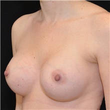 Breast Augmentation After Photo by Judith Gurley, M.D., F.A.C.S.; Chesterfield, MO - Case 49068