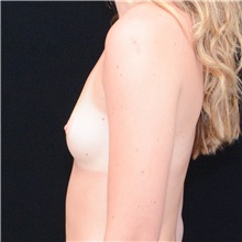 Breast Augmentation Before Photo by Judith Gurley, M.D., F.A.C.S.; Chesterfield, MO - Case 49071