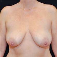 Breast Lift Before Photo by Judith Gurley, M.D., F.A.C.S.; Chesterfield, MO - Case 49073