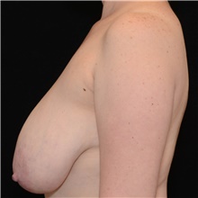 Breast Lift Before Photo by Judith Gurley, M.D., F.A.C.S.; Chesterfield, MO - Case 49075