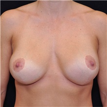 Breast Lift After Photo by Judith Gurley, M.D., F.A.C.S.; Chesterfield, MO - Case 49076