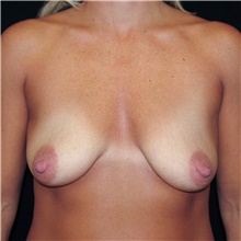 Breast Lift Before Photo by Judith Gurley, M.D., F.A.C.S.; Chesterfield, MO - Case 49076