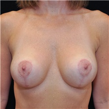 Breast Lift After Photo by Judith Gurley, M.D., F.A.C.S.; Chesterfield, MO - Case 49078