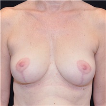 Breast Lift After Photo by Judith Gurley, M.D., F.A.C.S.; Chesterfield, MO - Case 49079