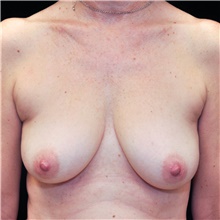 Breast Lift Before Photo by Judith Gurley, M.D., F.A.C.S.; Chesterfield, MO - Case 49079