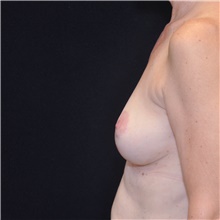 Breast Lift After Photo by Judith Gurley, M.D., F.A.C.S.; Chesterfield, MO - Case 49079