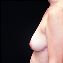 Breast Lift Before Photo by Judith Gurley, M.D., F.A.C.S.; Chesterfield, MO - Case 49079