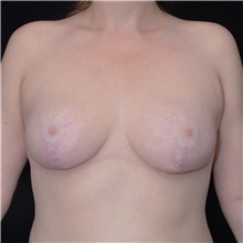 Breast Lift After Photo by Judith Gurley, M.D., F.A.C.S.; Chesterfield, MO - Case 49080