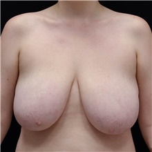 Breast Lift Before Photo by Judith Gurley, M.D., F.A.C.S.; Chesterfield, MO - Case 49080