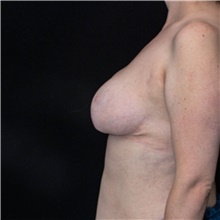 Breast Lift After Photo by Judith Gurley, M.D., F.A.C.S.; Chesterfield, MO - Case 49080