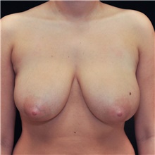 Breast Reduction Before Photo by Judith Gurley, M.D., F.A.C.S.; Chesterfield, MO - Case 49086