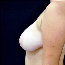 Breast Reduction Before Photo by Judith Gurley, M.D., F.A.C.S.; Chesterfield, MO - Case 49087