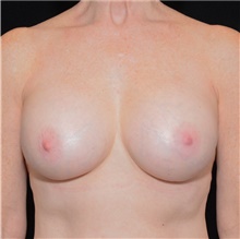 Breast Implant Revision After Photo by Judith Gurley, M.D., F.A.C.S.; Chesterfield, MO - Case 49089