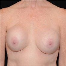 Breast Implant Revision Before Photo by Judith Gurley, M.D., F.A.C.S.; Chesterfield, MO - Case 49089