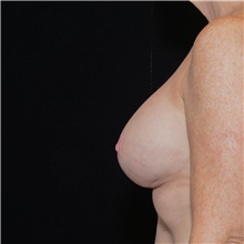 Breast Implant Revision After Photo by Judith Gurley, M.D., F.A.C.S.; Chesterfield, MO - Case 49089