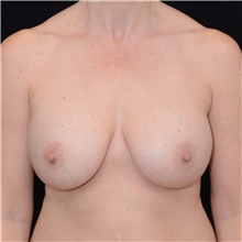 Breast Implant Removal Before Photo by Judith Gurley, M.D., F.A.C.S.; Chesterfield, MO - Case 49095