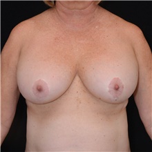 Breast Implant Removal Before Photo by Judith Gurley, M.D., F.A.C.S.; Chesterfield, MO - Case 49097