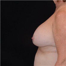 Breast Implant Removal Before Photo by Judith Gurley, M.D., F.A.C.S.; Chesterfield, MO - Case 49097