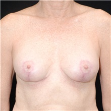 Breast Implant Removal After Photo by Judith Gurley, M.D., F.A.C.S.; Chesterfield, MO - Case 49098