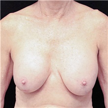 Breast Implant Removal Before Photo by Judith Gurley, M.D., F.A.C.S.; Chesterfield, MO - Case 49098