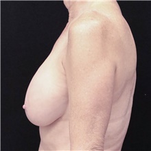 Breast Implant Removal Before Photo by Judith Gurley, M.D., F.A.C.S.; Chesterfield, MO - Case 49098