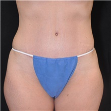 Tummy Tuck After Photo by Judith Gurley, M.D., F.A.C.S.; Chesterfield, MO - Case 49105