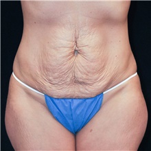 Tummy Tuck Before Photo by Judith Gurley, M.D., F.A.C.S.; Chesterfield, MO - Case 49105