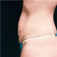 Tummy Tuck Before Photo by Judith Gurley, M.D., F.A.C.S.; Chesterfield, MO - Case 49105