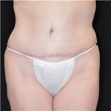 Tummy Tuck After Photo by Judith Gurley, M.D., F.A.C.S.; Chesterfield, MO - Case 49107