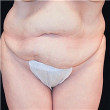 Tummy Tuck Before Photo by Judith Gurley, M.D., F.A.C.S.; Chesterfield, MO - Case 49107