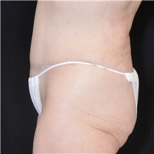 Tummy Tuck After Photo by Judith Gurley, M.D., F.A.C.S.; Chesterfield, MO - Case 49107