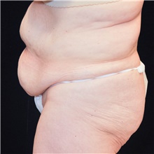 Tummy Tuck Before Photo by Judith Gurley, M.D., F.A.C.S.; Chesterfield, MO - Case 49107